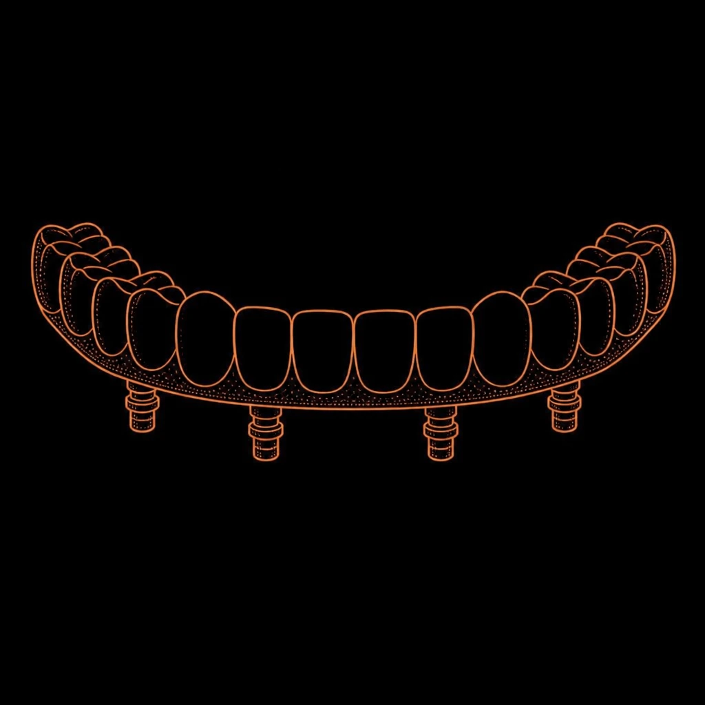 Illustration: feste Vollbogenbrücke auf vier Implantaten