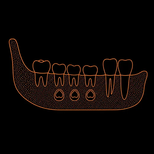 Esquema: dentición mixta vista de lado – un nuevo molar grande al fondo, dientes frontales permanentes y, entre ellos, dientes de leche con gérmenes dentales en el hueso