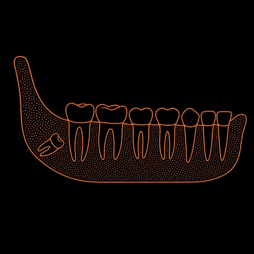 Esquema: dentición permanente de un adolescente vista de lado, con el germen de una muela del juicio en el hueso, al fondo