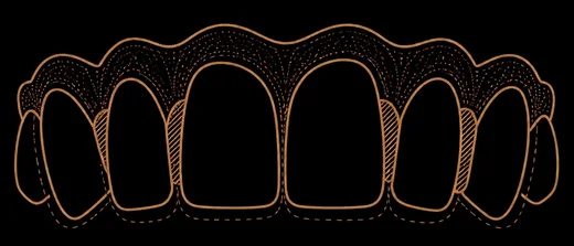 Esquema: la misma hilera de dientes en movimiento; un contorno fantasma discontinuo muestra la posición anterior del diente girado